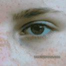 Freckles