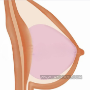 Gel-Filled Soft Breasts